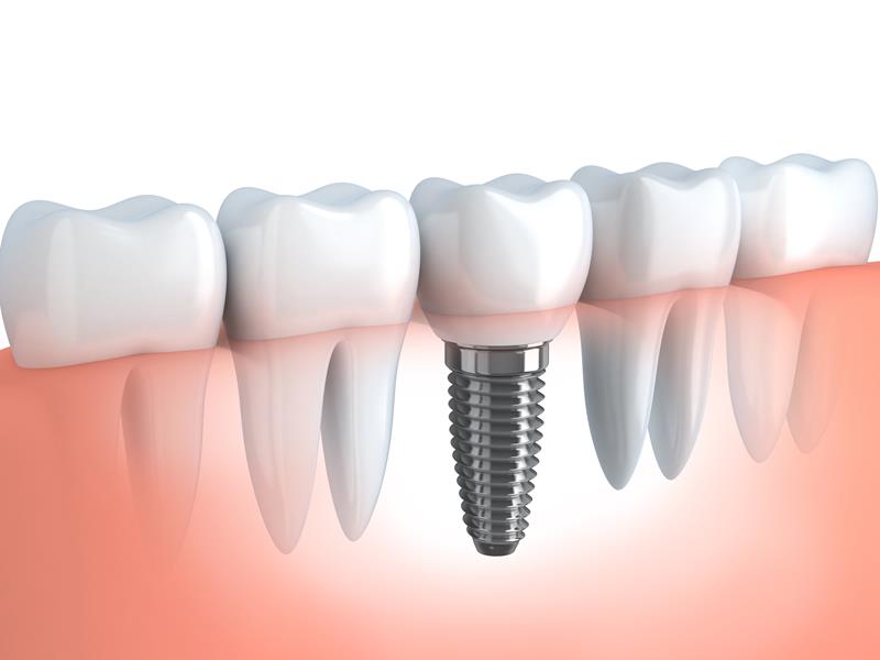 Dental Implants Boyertown, PA 